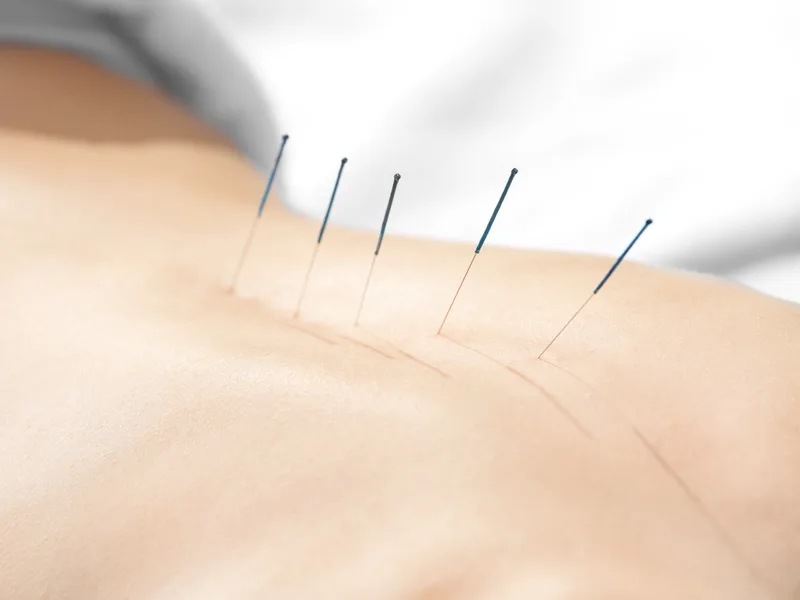 Acupuncture at Full Circle Health in Chesterfield